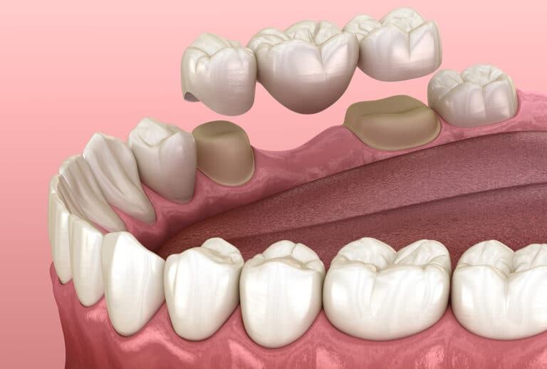 dental implants las vegas