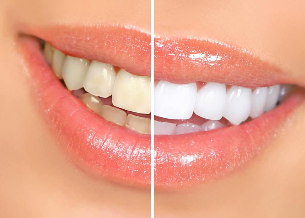 teeth whitening image