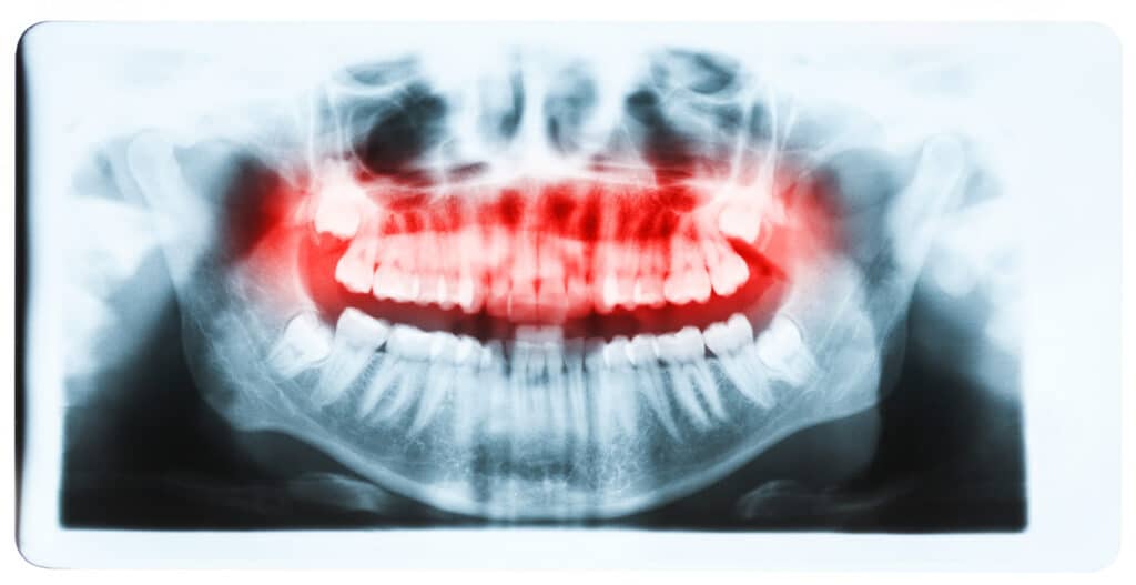 xray upper teeth