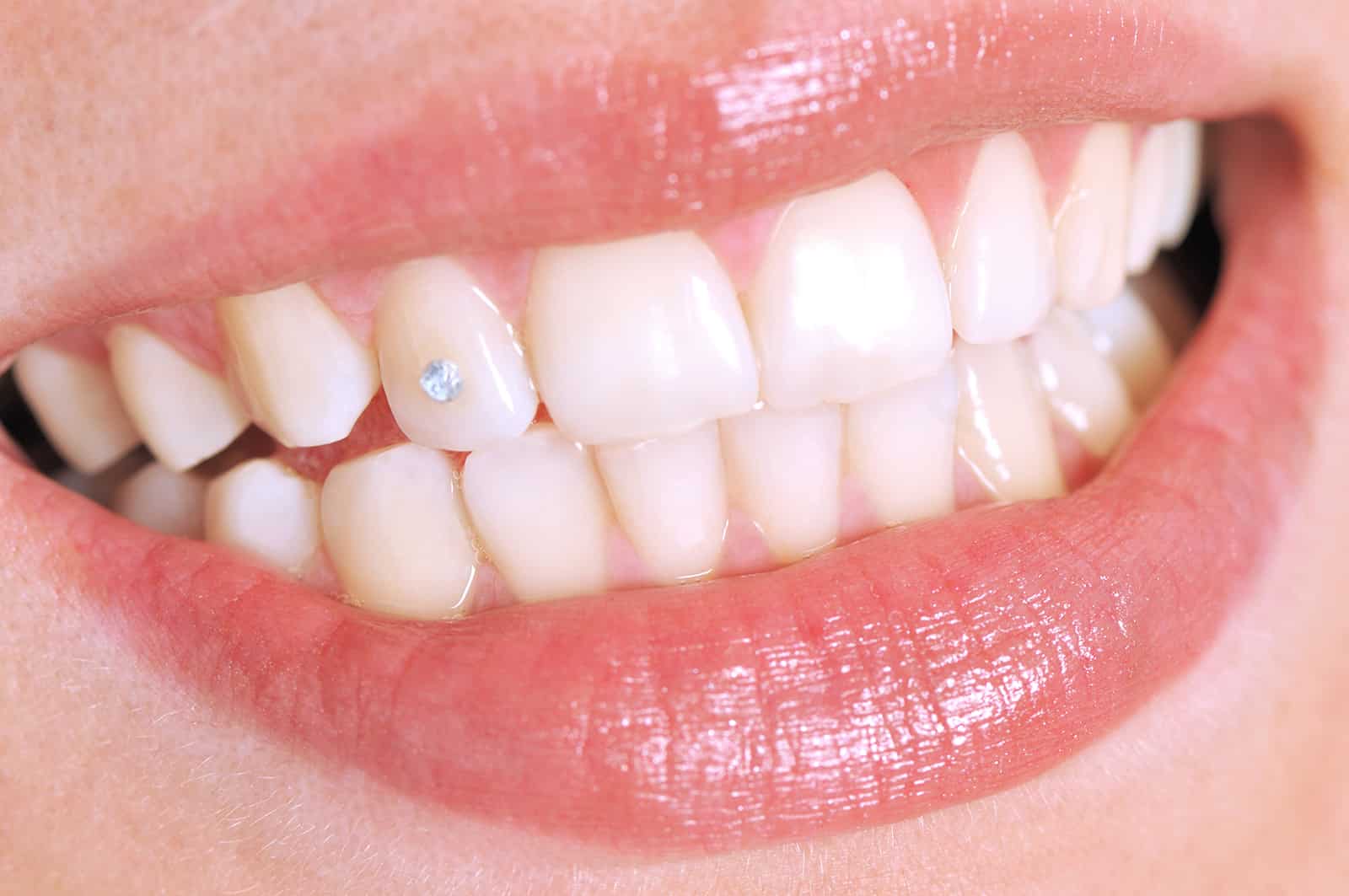 Dental jewelry image