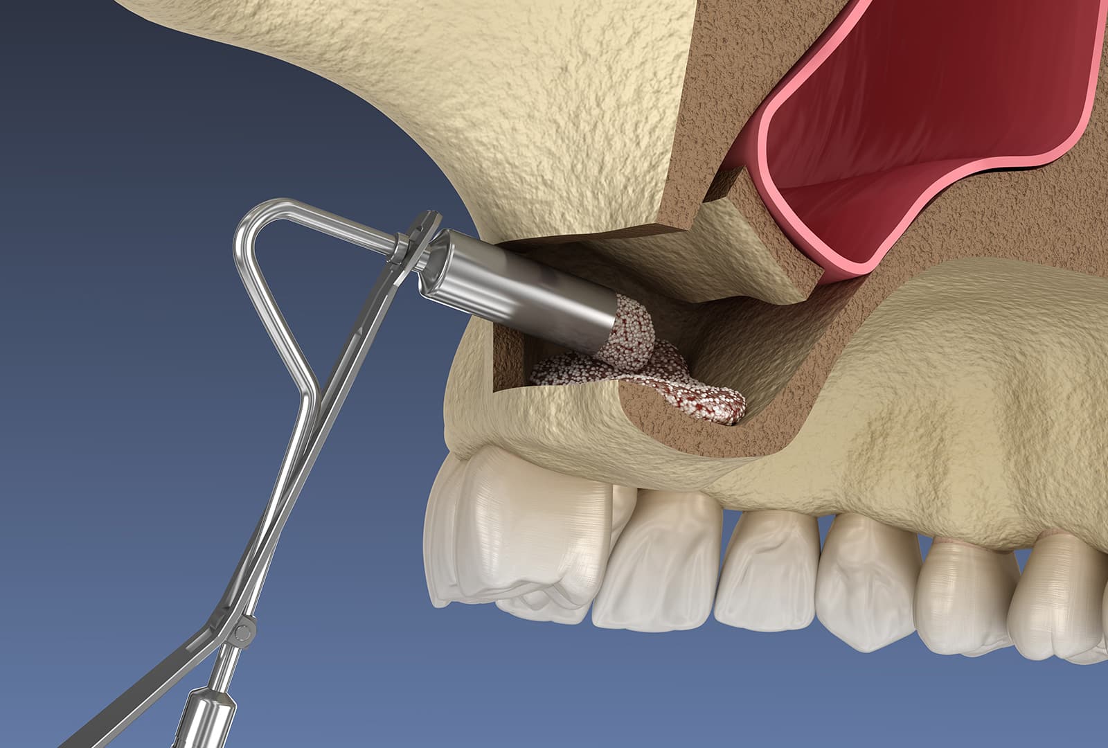 Sinus Lifts - Millennium Dental
